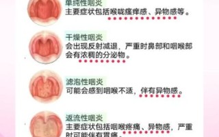 孕妇嗓子疼怎么办_孕妇嗓子疼能吃什么药