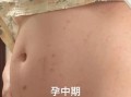 孕妇胆汁淤积是哪里痒_胆汁淤积瘙痒部位图解