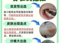 孕妇血小板低能顺产吗_血小板低顺产风险
