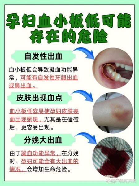 孕妇血小板低能顺产吗_血小板低顺产风险-第1张图片-星辰妙记 孕妇血小板低能顺产吗_血小板低顺产风险-第1张图片-星辰妙记