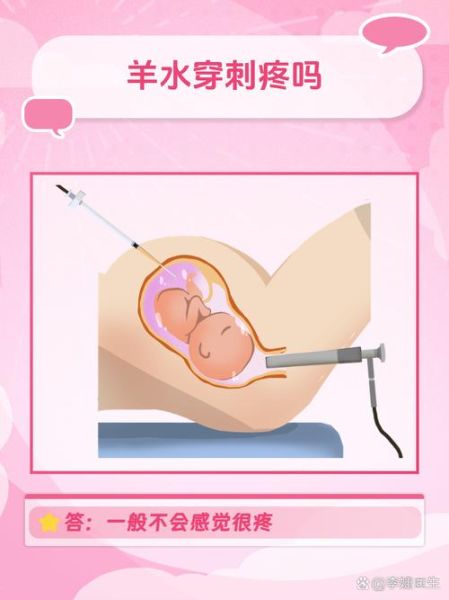 孕妇做羊水穿刺对胎儿有影响吗_羊水穿刺风险大不大-第1张图片-星辰妙记 孕妇做羊水穿刺对胎儿有影响吗_羊水穿刺风险大不大-第1张图片-星辰妙记
