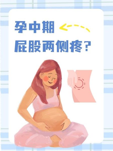 孕妇屁股疼怎么办_孕妇屁股疼怎么缓解-第2张图片-星辰妙记 孕妇屁股疼怎么办_孕妇屁股疼怎么缓解-第2张图片-星辰妙记