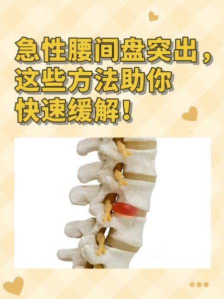 孕妇腰间盘突出能顺产吗_孕期腰突如何缓解疼痛-第3张图片-星辰妙记 孕妇腰间盘突出能顺产吗_孕期腰突如何缓解疼痛-第3张图片-星辰妙记