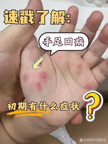 手足口病孕妇会传染给胎儿吗_孕期感染怎么办-第1张图片-星辰妙记