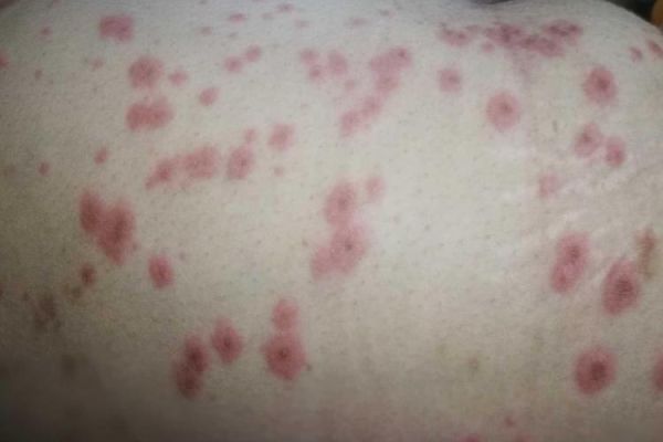 孕妇胆汁淤积是哪里痒_胆汁淤积瘙痒部位图解-第3张图片-星辰妙记 孕妇胆汁淤积是哪里痒_胆汁淤积瘙痒部位图解-第3张图片-星辰妙记