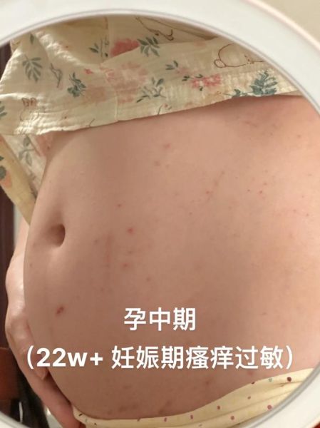 孕妇胆汁淤积是哪里痒_胆汁淤积瘙痒部位图解-第1张图片-星辰妙记 孕妇胆汁淤积是哪里痒_胆汁淤积瘙痒部位图解-第1张图片-星辰妙记