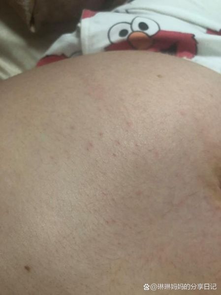 孕妇肚子上起了好多小红点_对胎儿有影响吗-第2张图片-星辰妙记