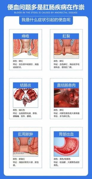 孕妇大便出血是怎么回事_孕妇便血怎么办-第2张图片-星辰妙记