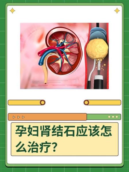 孕妇结石怎么办_孕妇结石对胎儿有影响吗-第1张图片-星辰妙记 孕妇结石怎么办_孕妇结石对胎儿有影响吗-第1张图片-星辰妙记