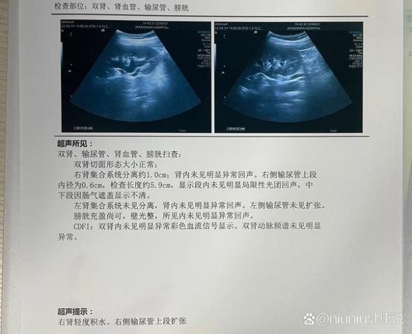 孕妇结石怎么办_孕妇结石对胎儿有影响吗-第3张图片-星辰妙记 孕妇结石怎么办_孕妇结石对胎儿有影响吗-第3张图片-星辰妙记